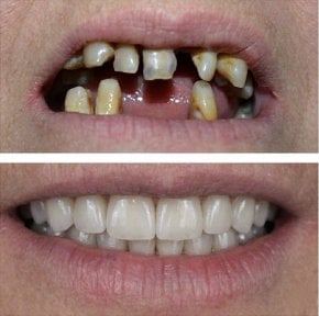 before-after photo all-on-6-dental-implants