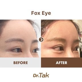 نتائج شد العيون (فوكس آي) قبل وبعد في عيادة Dr. Tak Plastic Surgery، رفع محيط العين