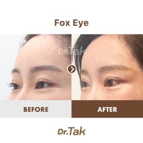 نتائج شد الجفن بأسلوب fox eye قبل وبعد في Dr. Tak Plastic Surgery، مظهر جفن مرفوع