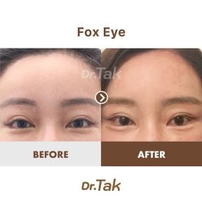 نتائج قبل وبعد جراحة فوكس آي في عيادة Dr. Tak Plastic Surgery، رفع الجفن