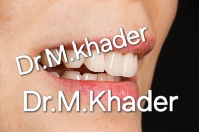 before-after photo emax-veneers