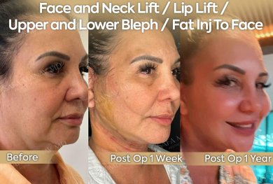 before-after photo tightening-of-facial-skin-facelift