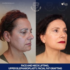 before-after photo tightening-of-facial-skin-facelift