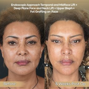 before-after photo tightening-of-facial-skin-facelift