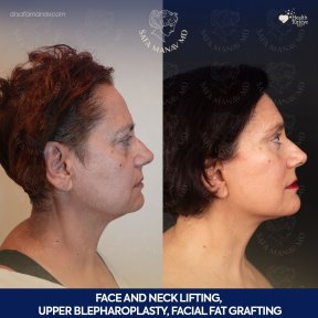 before-after photo tightening-of-facial-skin-facelift