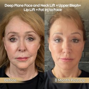 before-after photo tightening-of-facial-skin-facelift