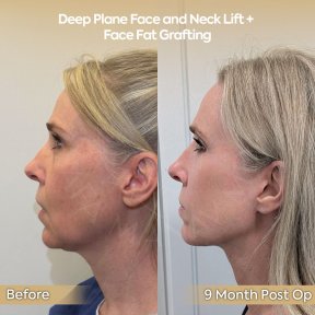before-after photo tightening-of-facial-skin-facelift