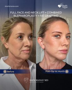 before-after photo tightening-of-facial-skin-facelift