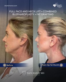 before-after photo tightening-of-facial-skin-facelift