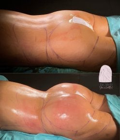 before-after photo liposuction