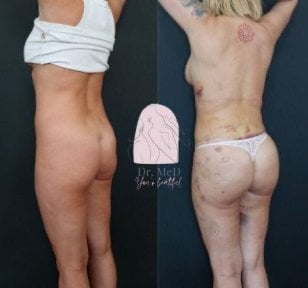 before-after photo liposuction