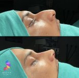 نتائج عملية تجميل الأنف قبل وبعد في Bella Clinic، تحسين شكل الأنف والملف الجانبي