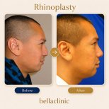 نتائج عملية تجميل الأنف قبل وبعد في bellaclinic، إعادة تشكيل الأنف لتحسين المظهر الجانبي