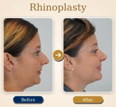 نتائج عملية تجميل الأنف قبل وبعد – تحسين شكل الأنف والملف الجانبي بعد الجراحة