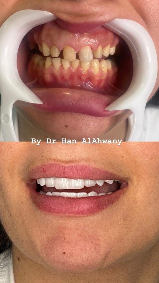 نتائج قبل وبعد عدسات الأسنان مع د. هان الأحواني – ابتسامة طبيعية وجذابة