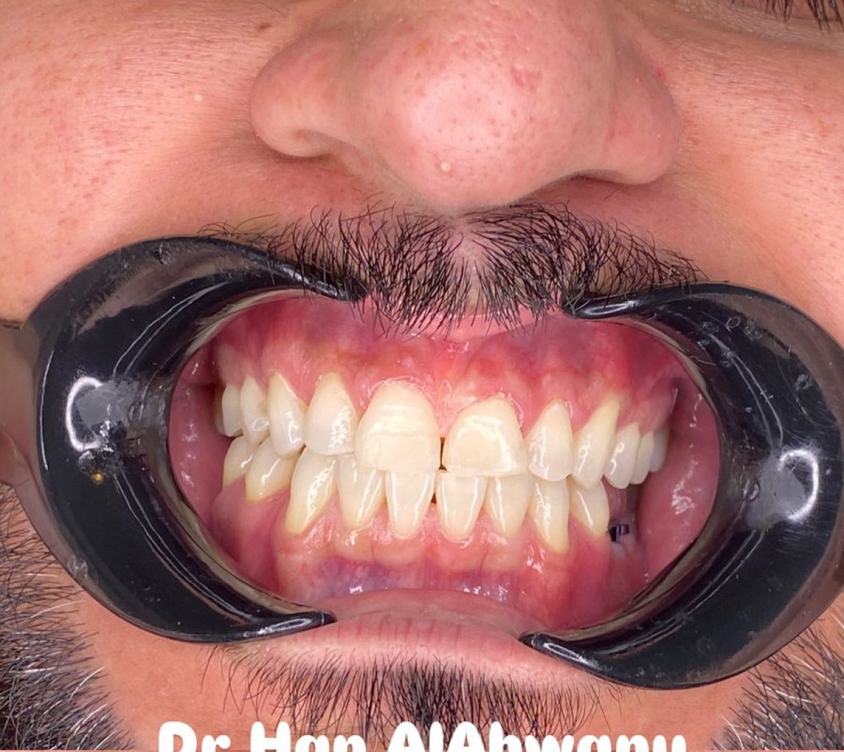 نتيجة علاج Invisalign تظهر تحسن انتظام الأسنان وتصحيح الابتسامة