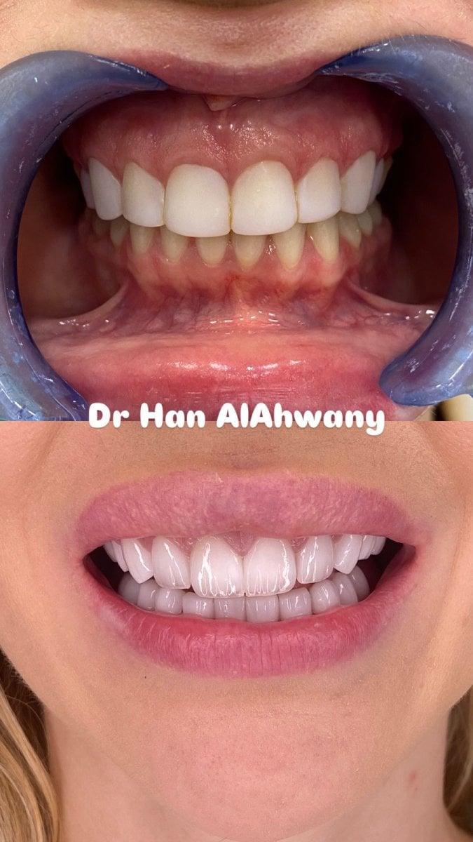 نتيجة قبل وبعد الفينير مع Dr Han AlAhwany – تحول الابتسامة بالفينير