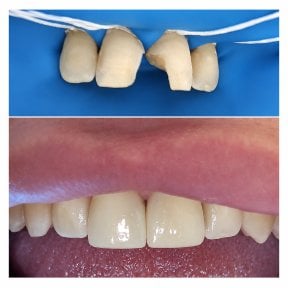 before-after photo aesthetic-composite-filling