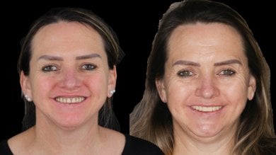 before-after photo dental-crown-installation