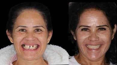 before-after photo dental-crown-installation