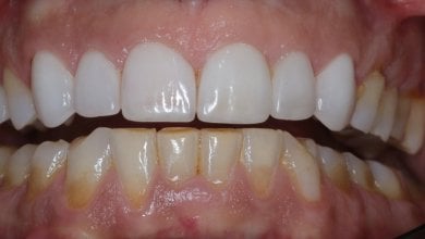 before-after photo dental-crown-installation