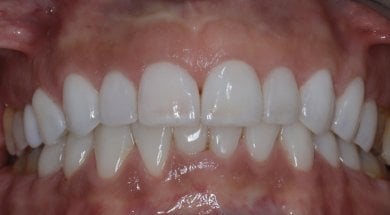 before-after photo dental-crown-installation