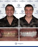 Результаты до и после установки циркониевых коронок в Inter Dental Turkey – преображение улыбки