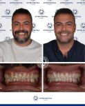 Результаты до и после установки коронок из циркония в Inter Dental Turkey – белоснежная улыбка