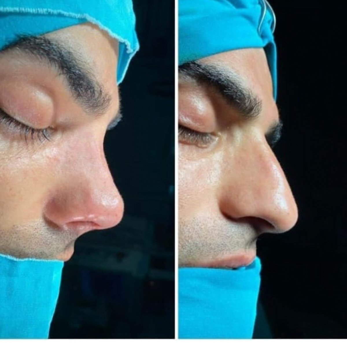 Resultados antes y después de septoplastia, perfil nasal mejorado tras cirugía
