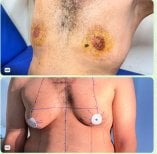 Before and after gynecomastia surgery results, male chest contour improvement
