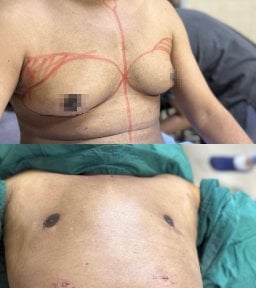 Before and after gynecomastia Vaser liposuction results – flatter chest contour improvement
