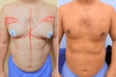Before and after gynecomastia Vaser liposuction results – improved male chest contour