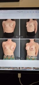 before-after photo breast-augmentation