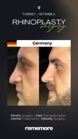 before-after photo rhinoplasty-nose-job
