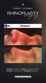 before-after photo rhinoplasty-nose-job