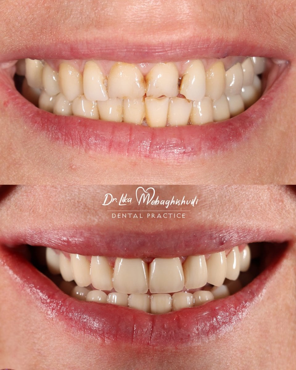 نتائج قبل وبعد عدسات الأسنان في عيادة Dr. Lika Mebaghishvili، ابتسامة جديدة