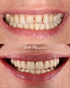 Porcelain veneer before and after results at Dr. Lika Mebaghishvili Dental Practice, smile makeover