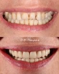Porcelain veneer before and after results at Dr. Lika Mebaghishvili Dental Practice, smile makeover