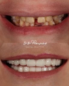 نتائج قبل وبعد تركيب تيجان الزركونيا في عيادة Dr. Lika Mebaghishvili لابتسامة جديدة