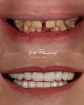 نتائج قبل وبعد تركيب تيجان الزركونيا في عيادة Dr. Lika Mebaghishvili لابتسامة جديدة