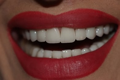 Porcelain veneer result – bright, even smile after dental veneers procedure