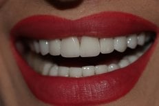 Porcelain veneer result – bright, even smile after dental veneers procedure