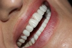 Porcelain veneer result showing bright, even teeth after dental treatment