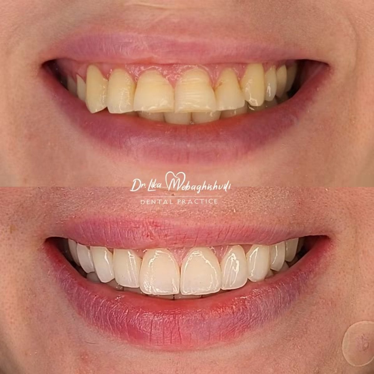 نتائج قبل وبعد تركيب تيجان الزركونيا في عيادة Dr. Lika Mebagishvili للأسنان