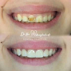 Vorher-nachher Zahnrestauration bei Dr. Lika Mebaghishvili – verbesserte Frontzähne