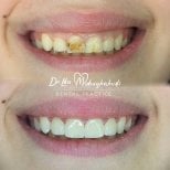 Vorher-nachher Zahnrestauration bei Dr. Lika Mebaghishvili – verbesserte Frontzähne
