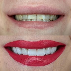 Before and after veneers result – whiter, even teeth and enhanced smile transformation