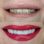 Before and after veneers result – whiter, even teeth and enhanced smile transformation