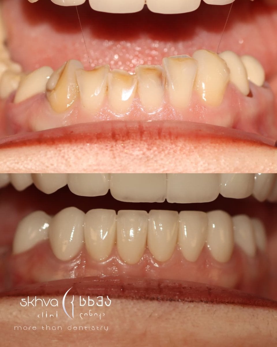 Resultado de carillas antes y después en Skhva Clinic: sonrisa renovada y natural