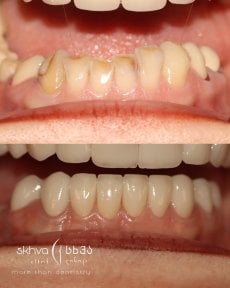 Before and after veneers result at Skhva Clinic – smile makeover with natural-looking teeth